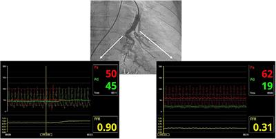 Balloon pulmonary angioplasty can be an effective and safe therapeutic option in non-surgical elderly patients